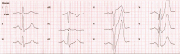 Abbildung 5: EKG