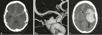Abbildung 6a-c: Blister-Aneurysma