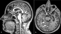 Abbildung 2: M2-Aneurysma