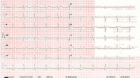 Abbildung 6: EKG