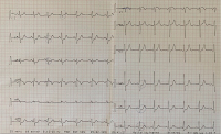 Abbildung 1: EKG