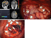 Abbildung 4A-C: Intraoperative Stimulation