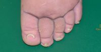 Abbildung 4: Papillomatosis  cutis lymphostatica