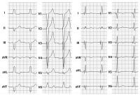 Abbildung 8: EKG