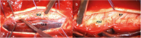 Abbildung 3a-b: Intraoperative Bilder