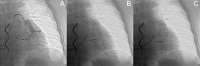Abbildung 1: CardioMEMS™ HF-System - Implantation