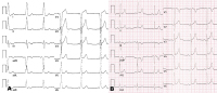 Abbildung 1: Ablation