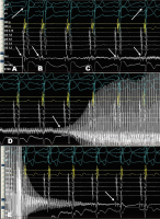 Abbildung 5: Kryo-Ablation