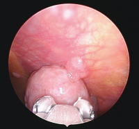 Abbildung 5: Epitheloides Mesotheliom