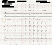Abbildung 1: EKG