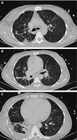Abbildung 4A-C: Thorax-CT