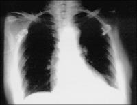 Figure 1: Lungeninfiltrat