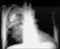 Figure 2: Lungeninfiltrat