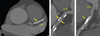 Abbildung 2: Coronary-CT