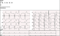 Abbildung 1: EKG