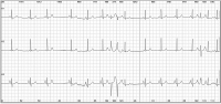 Abbildung 1: Langzeit-EKG