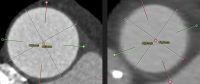 Abbildung 4: Aorta ascendens