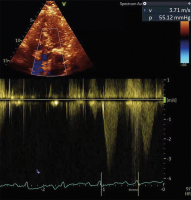 Abbildung 7: Fall 3: LVOT-Gradient