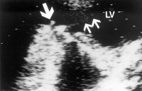 Figure 3: Endokarditis - Diagnose - TEE