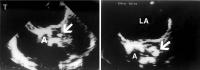Figure 4: Endokarditis - Diagnose - TEE