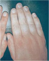 Abbildung 1: Raynaud-Phänomen