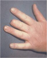 Abbildung 2: Raynaud-Phänomen