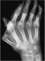 Abbildung 8: Raynaud-Phänomen
