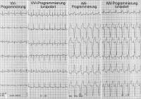 Abbildung 2: Schrittmacher-EKG - Elektrodenanschlußproblem