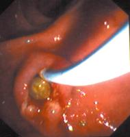 Abbildung 4: Bouveret-Syndrom