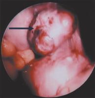 Abbildung 5: Leiomyomatöse Omentum majus-Neoplasie