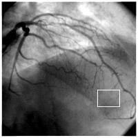 Figure 1: R. interventricularis anterior - Stenose