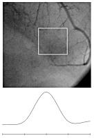 Figure 2: R. interventricularis anterior - Stenose