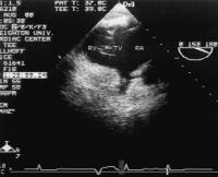 Figure 1: Rechtsatrialer Appendix