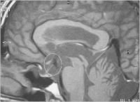 Abbildung 2: Hydrozephalus beim Erwachsenen