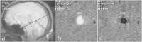Abbildung 4a-c: Hydrozephalus beim Erwachsenen