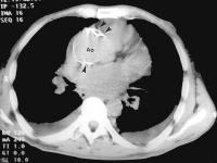 Figure 3: Mediastinale Masse