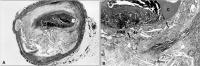 Figure 1A-B: Plaqueverteilung und Thrombose