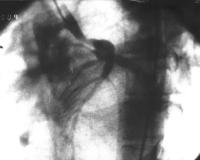 Figure 1: Koronare Anomalie