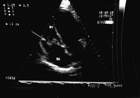 Figure 1: Rechtsseitige Endokarditis