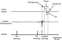 Abbildung 2: Kardiale Kontraktilitätsmodulation