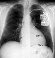 Abbildung 4: Implantierbarer Impulsgenerator