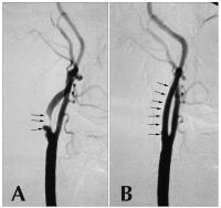 Abbildung 1A-B: Arteria carotic - Stenose - Stent