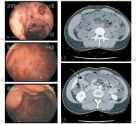 Abbildung 1a-e: Pneumotosis cystoides intestinalis