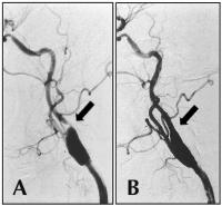 Abbildung 5A-B: Arteria carotis - Stenose - Stent