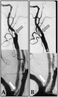 Abbildung 6A-B: Arteria carotis - Stenose - Stent