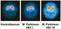 Abbildung 2: Morbus Parkinson - SPECT