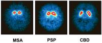 Abbildung 3: Morbus Parkinson - SPECT