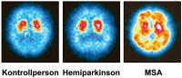 Abbildung 4: Morbus Parkinson - SPECT