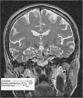 Abbildung 2: Morbus Parkinson - Nucleus subthalamicus