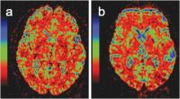 Abbildung 4: MSA - Diffusion weighted imaging